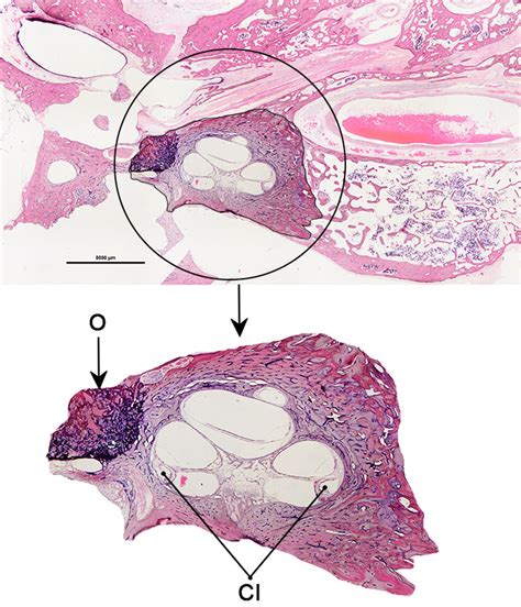 Dr. Chris Desouza Surgeon for Cochlear implant