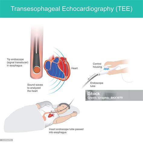 Illustrates The Transesophageal Echocardiography Procedure Stock ...