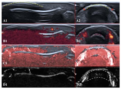 The Promising Role of a Superb Microvascular Imaging Technique in the ...