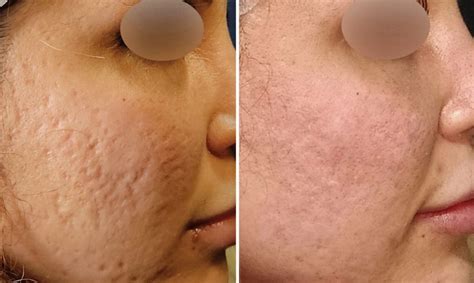 Microneedling RF & RF Laser for Acne Scars: Effective Treatments That Work