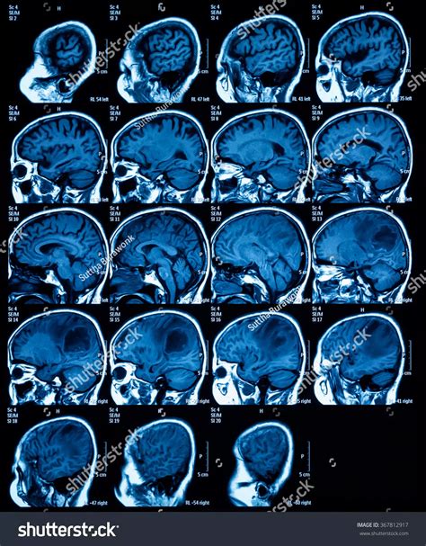 Brain Mri Tumor