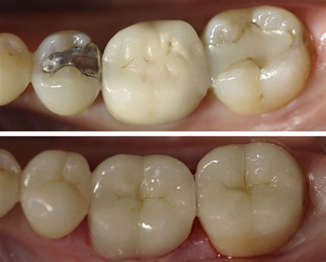Pin by Priyanta Jain on Dental | Dental fillings, Dental restoration, Restorative dentistry