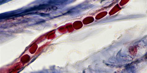 What is Cerebral Cavernous Malformation? | OnlyMyHealth