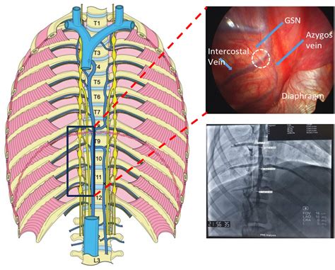 Endovascular Ablation of the Right Greater Splanchnic Nerve in Heart ...