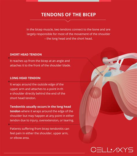 Therapy For Biceps Tendonitis at Maria Elsberry blog