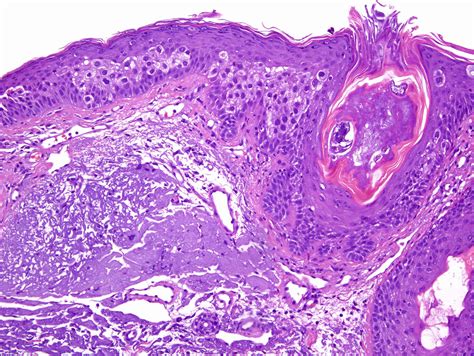 Hypertrophic Actinic Keratosis