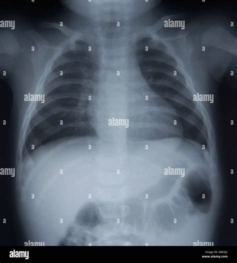 frontal view of normal pediatric chest x-ray Stock Photo - Alamy