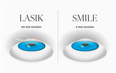 Smile Vs Lasik