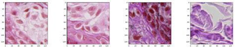 Semi-Supervised Nests of Melanocytes Segmentation Method Using ...