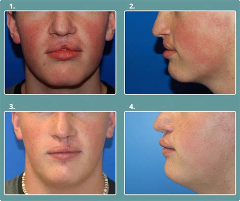 Before & After Cleft Lip & Palate - Michael Bateman, MD, PC