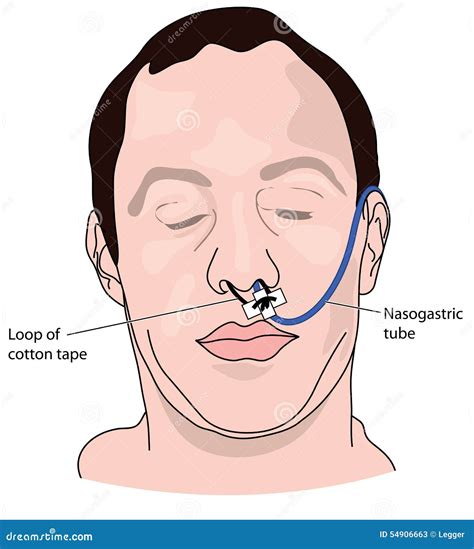 Nasogastric Tube Or NG Tube Cartoon Vector | CartoonDealer.com #145302721