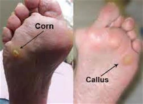 Corn | Common Foot Problems | South West Podiatry