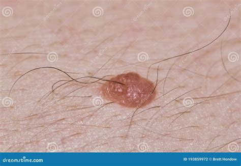 Hairy Nevus With Malignant Melanoma Royalty-Free Stock Photo ...