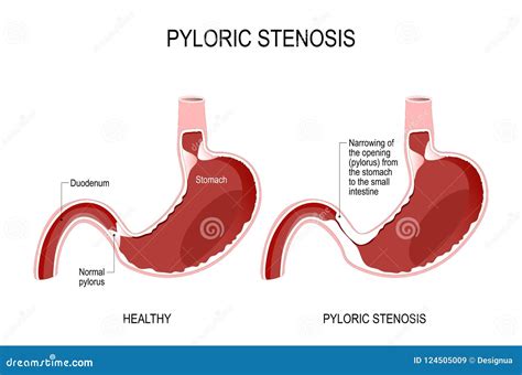 Spasms Of The Pylorus. Pylorospasm. Atonic. Pyloric Sphincter Of The Stomach. Infographics ...