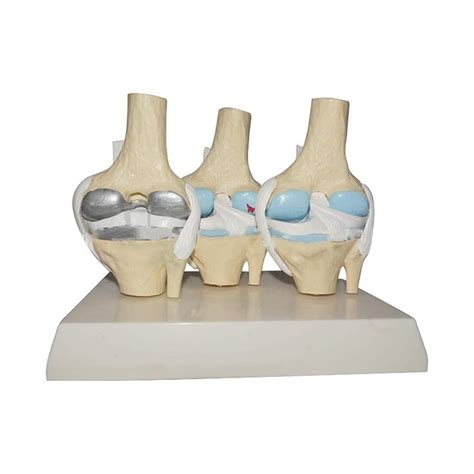 Hailia Csatai Human Knee Model Stages Of Lesions Knee Model ...