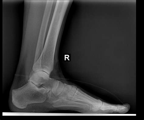 Lateral Foot X Ray Labeled at William Hulsey blog