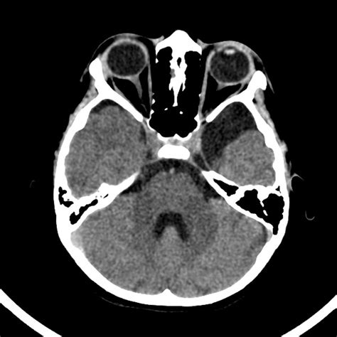 धब्बेदार Amyloidosis (Macular Amyloidosis) क्या है: लक्षण, कारण, और ...