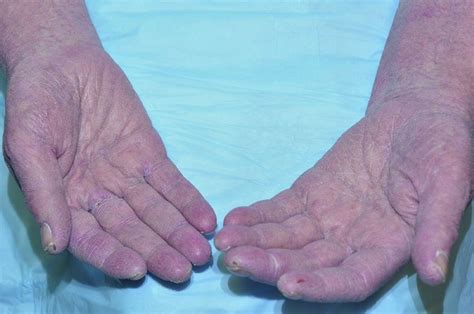 Dry Skin (Xeroderma) - Dry Skin (Xeroderma) - MSD Manual Consumer Version