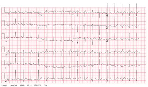 13 yo male - Minor RV conduction delay pattern : r/askCardiology