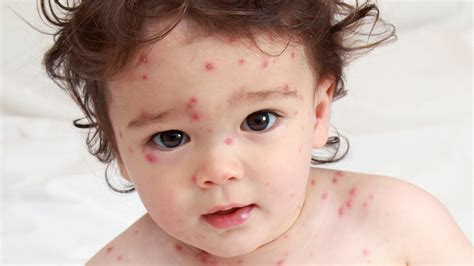 Infectious Diseases A-Z: Protect children from chickenpox infection ...