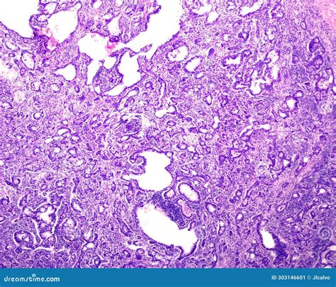 Human Prostate Cancer. Adenocarcinoma Stock Image - Image of oncology, light: 303146601