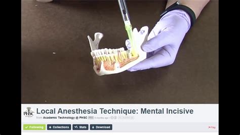 Extraoral Technique of Local Anesthesia 的图像结果