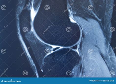 Knee injury mri mcl tear stock image. Image of meniscus - 182034875