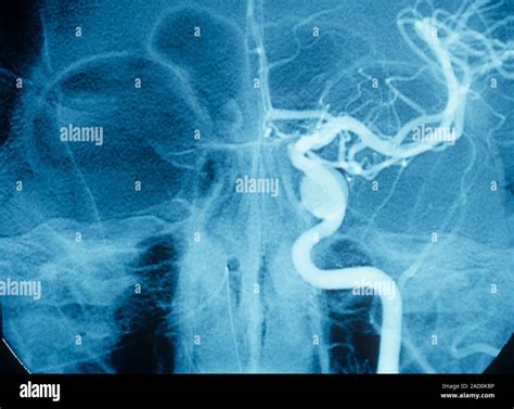 Treated carotid-cavernous fistula, X-ray. Angiogram of a carotid-cavernous fistula (CCF) that ...
