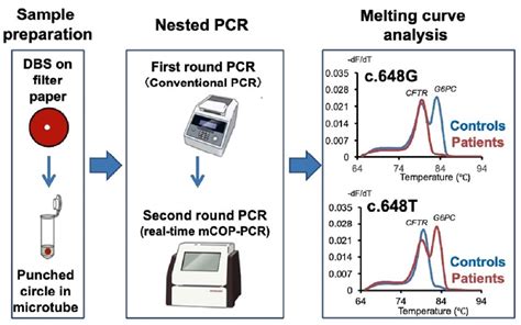 DBS Screening for Glycogen Storage Disease Type 1a: Detection of c.648G ...