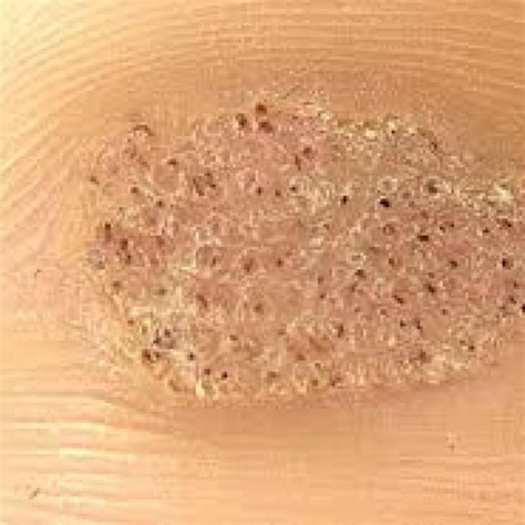 Plantar Wart Seeds