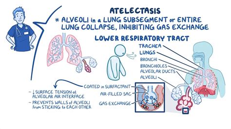 Video: Atelectasis: Nursing | Osmosis