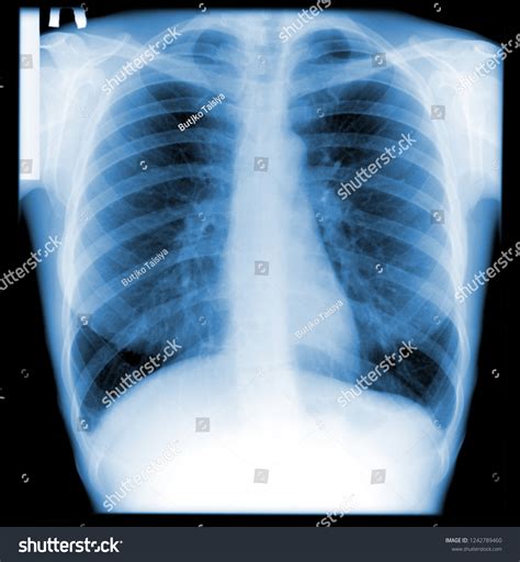 Bronchitis Lung X Ray