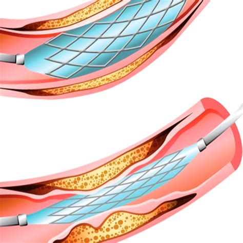 What are first generation stents? | FAQ answered by Dr. Viveka Kumar