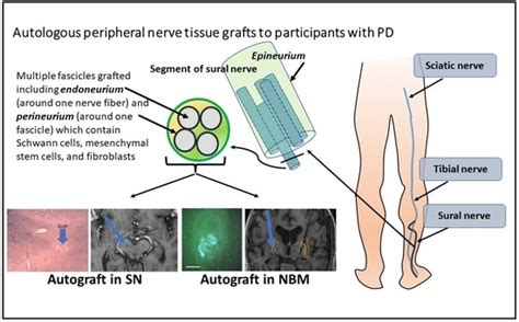 Recipient Reaction and Composition of Autologous Sural Nerve Tissue ...