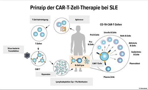 CAR-T-Zell-Therapie beim systemischen Lupus – ein neuer Meilenstein ...