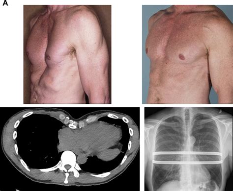 Success of Minimally Invasive Pectus Excavatum Procedures (Modified ...