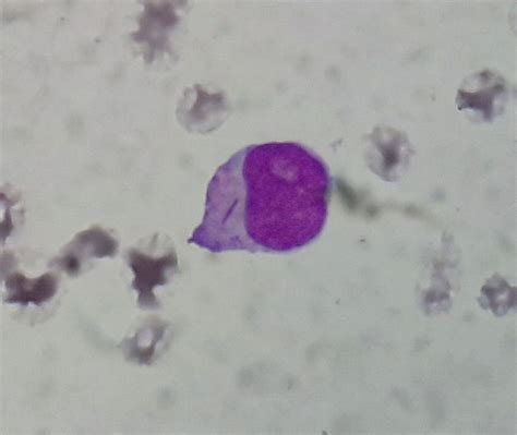 Acute Myeloid Leukemia - howitreat.in