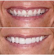 Image result for Dental Veneers Before and After