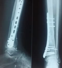 Study of distal tibial extra-articular fractures fixed with locking ...
