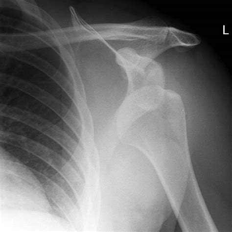 X Ray Shoulder Dislocation