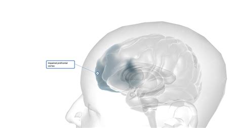 Image result for Prefrontal Cortex Damage