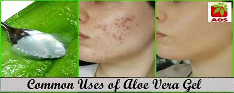 Common Benefits and Uses of Aloe Vera Gel | AOS Blog