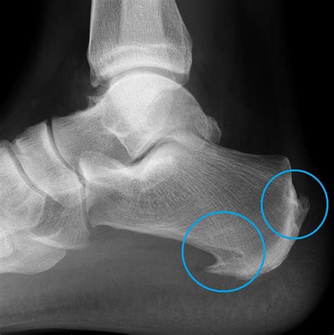 Heel Spurs | Dr Ben Beamond | Adelaide