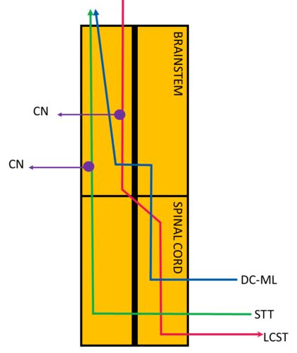 Image result for Contralateral Brain Injury