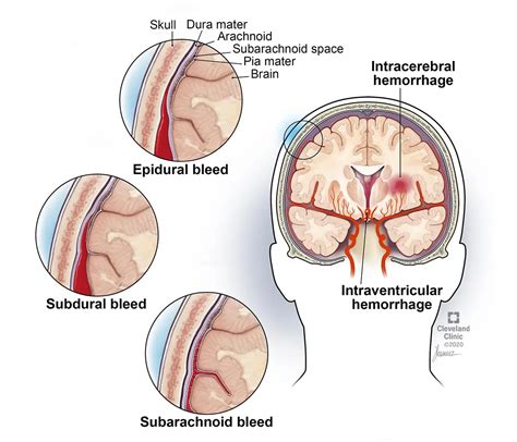 Hematoma Epidural Y Subdural: Tipos, Causas, Síntomas Y Tratamiento | Doctor Online