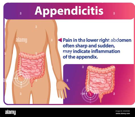 Illustration of appendicitis symptoms and affected area Stock Vector ...