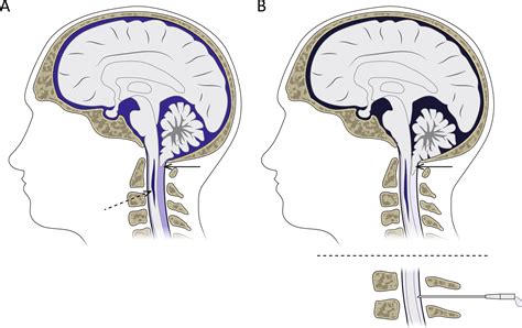 Arnold Chiari Malformation