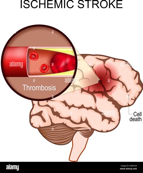 Causes Of Blood Clot In The Brain at Amelia Woodhouse blog