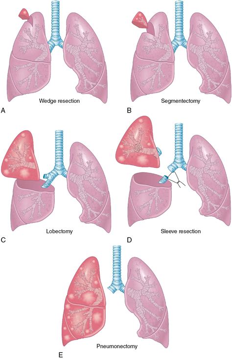 Surgical considerations in lung cancer treatment - Clinical Tree