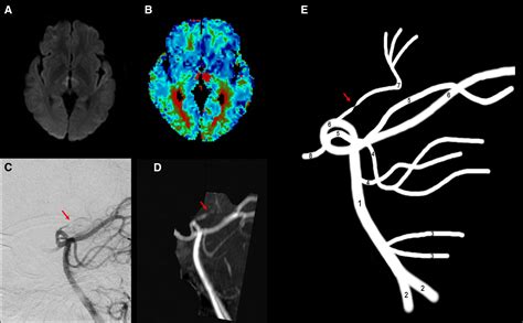Focal Severe Stenosis of the Artery of Percheron Revealed by Conventional Angiography in ...